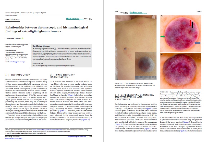 グロームス腫瘍