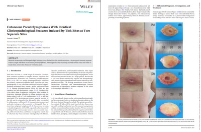 皮膚偽リンパ腫